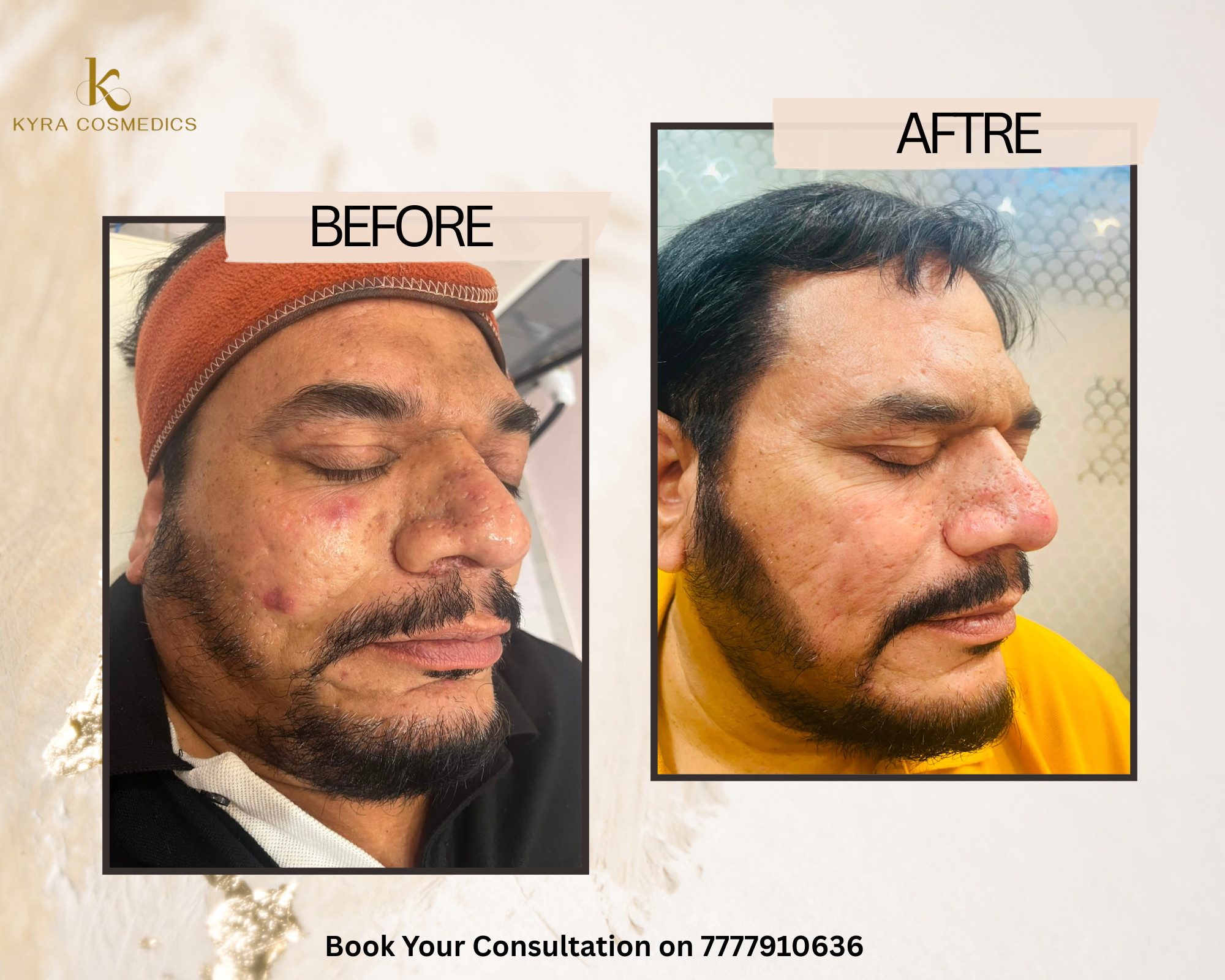 Male Cystic Acne & Inflammation Clearing real clinical result at Kyra Cosmedics Vadodara