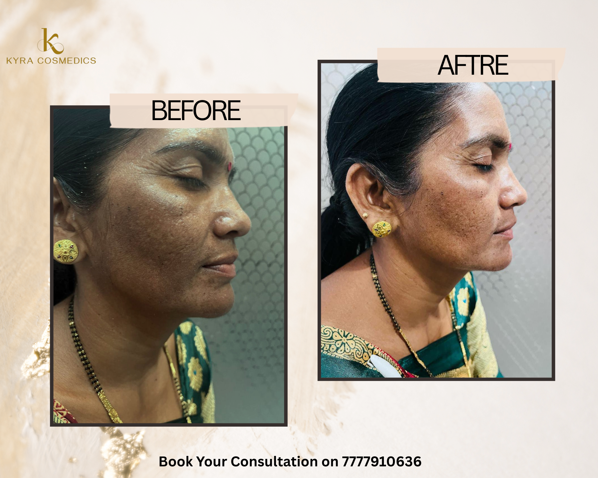 Chronic Melasma & Spot Management — Real clinical result at Kyra Cosmedics Vadodara