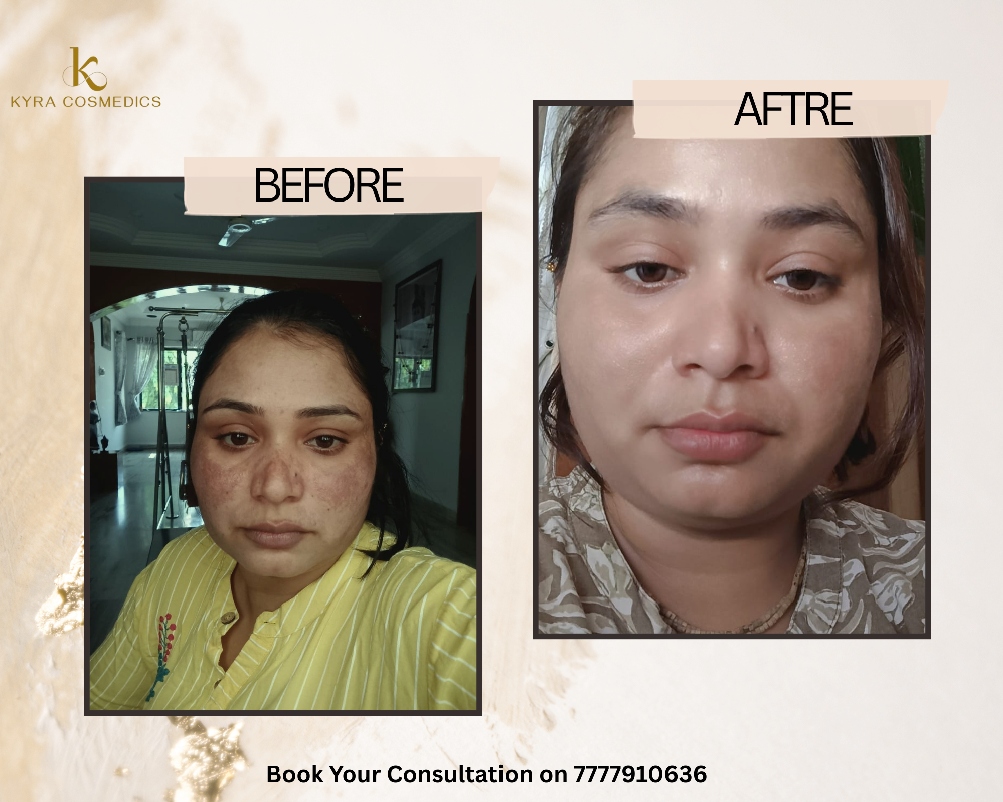 Deep Melasma & Pigmentation Fade real clinical result at Kyra Cosmedics Vadodara