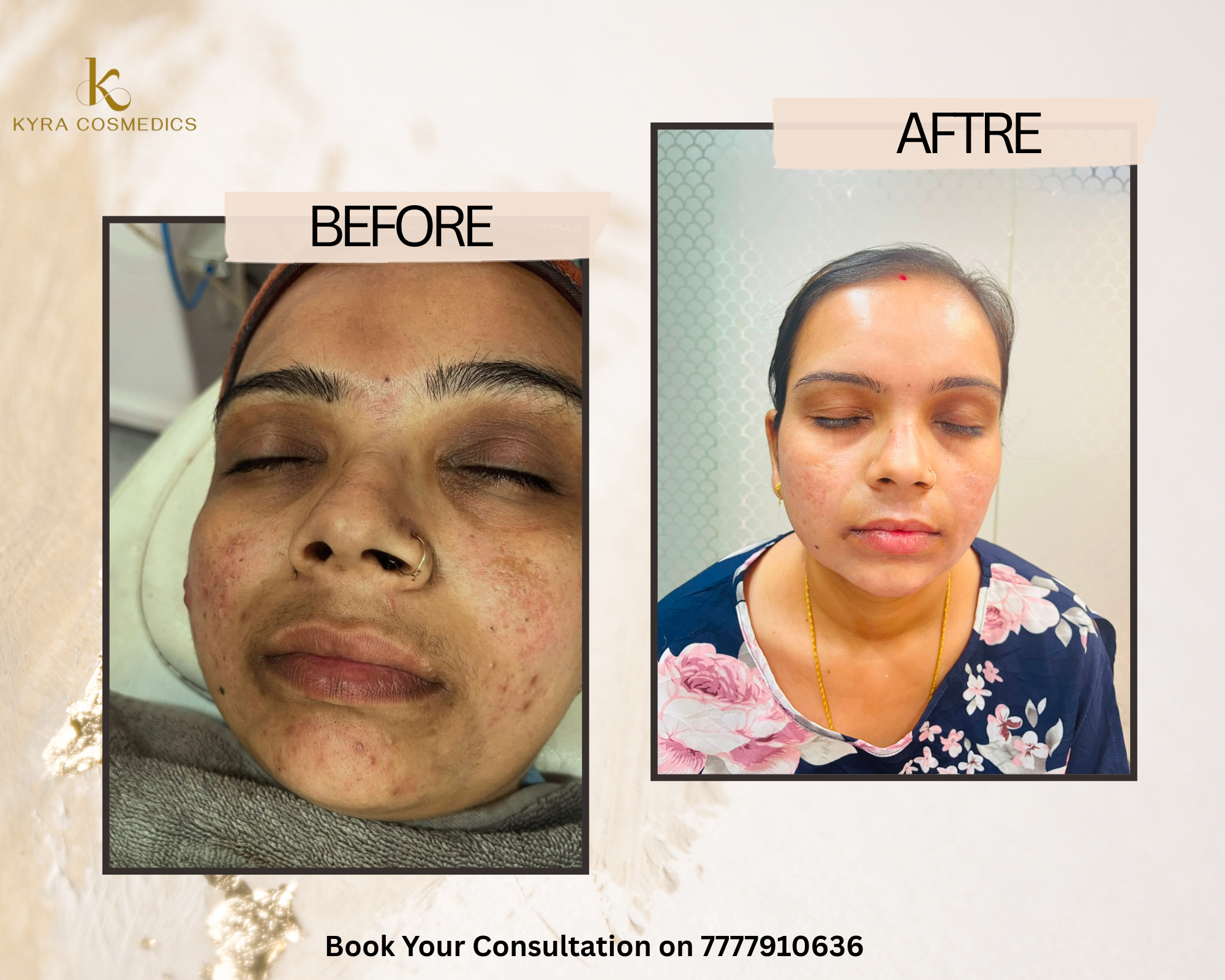 Under-Eye Dark Circles & Skin Brightening real clinical result at Kyra Cosmedics Vadodara
