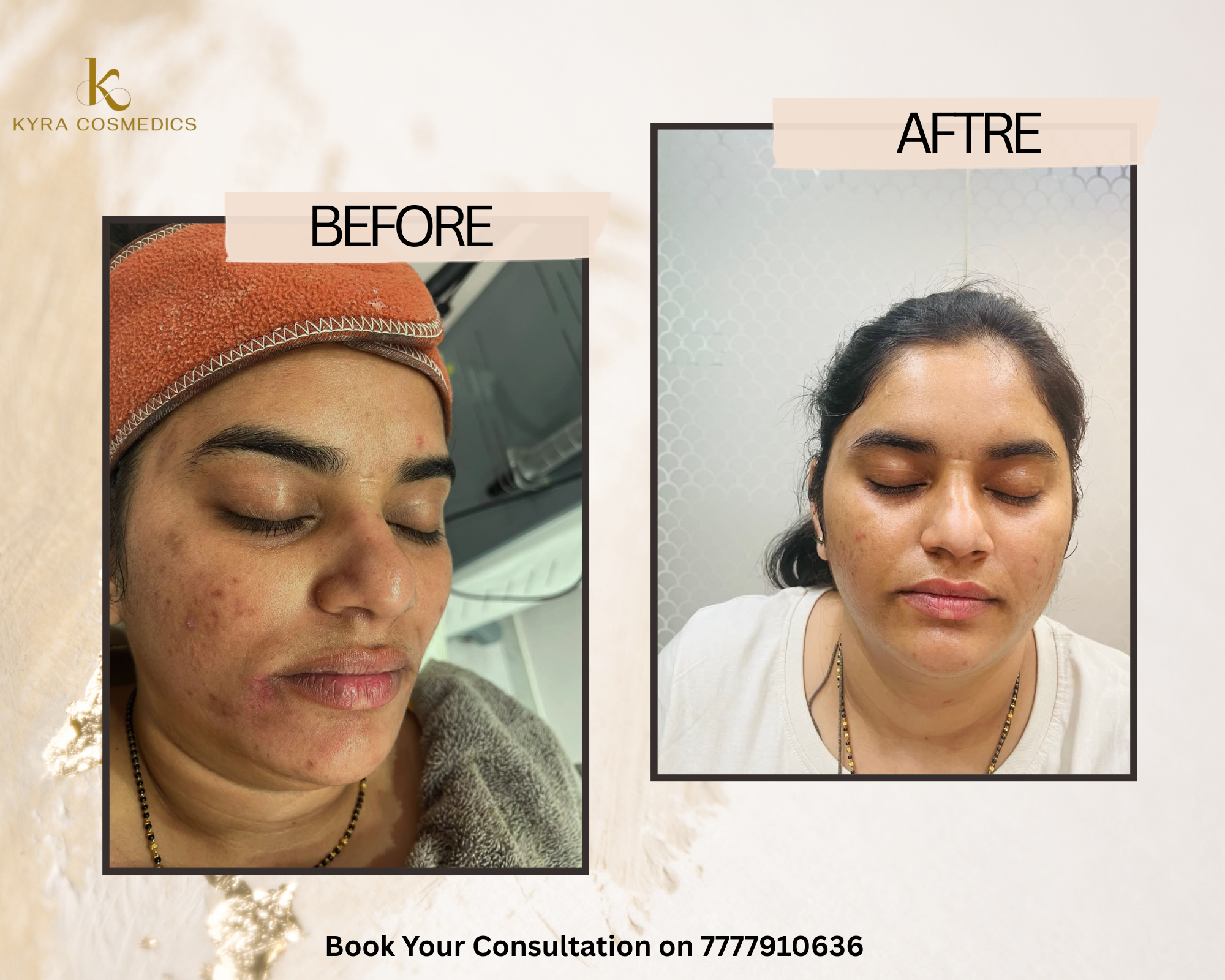 Active Acne & Post-Acne Mark Clearing real clinical result at Kyra Cosmedics Vadodara