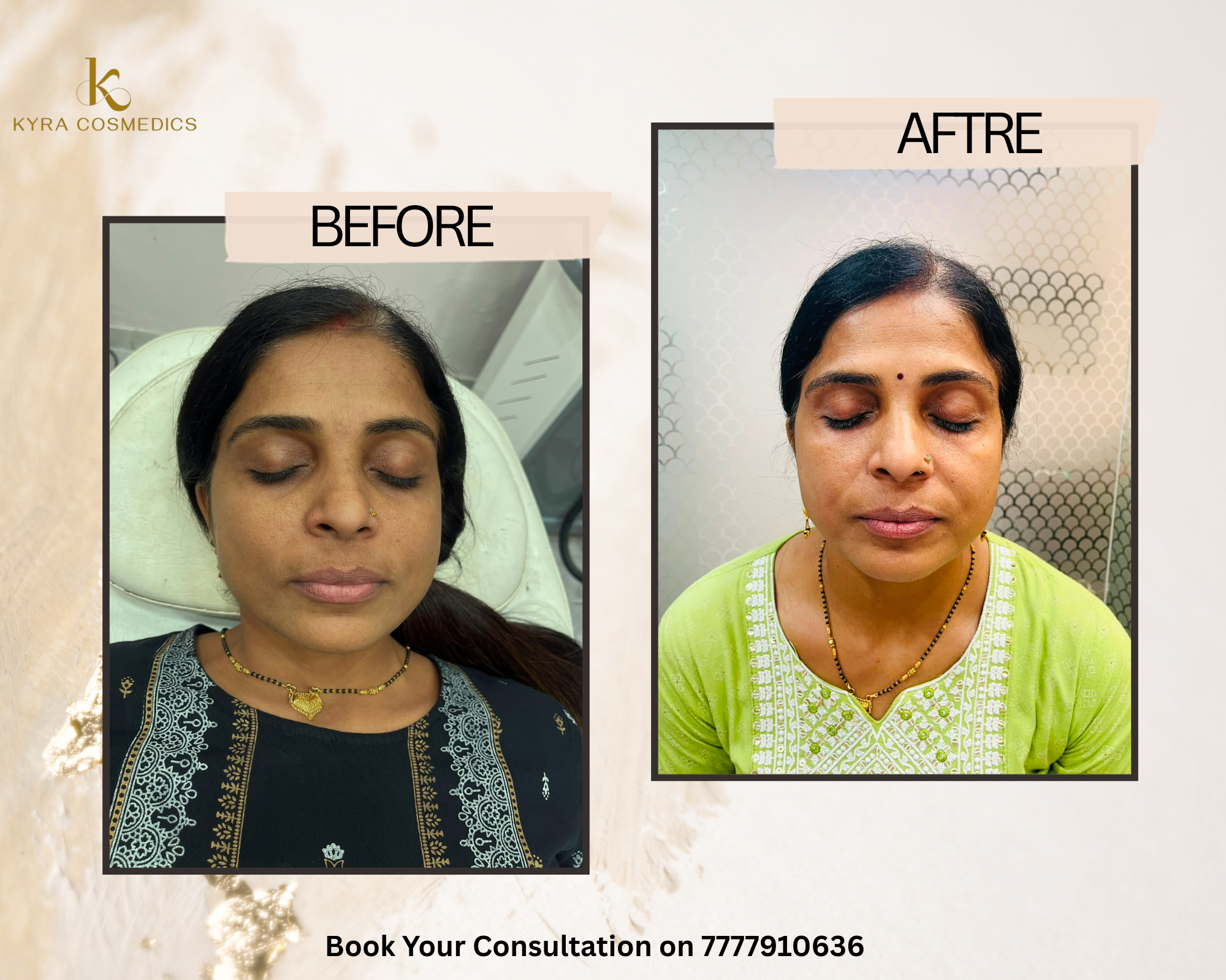 Facial Tone Evening & Radiance Renewal — Real clinical result at Kyra Cosmedics Vadodara