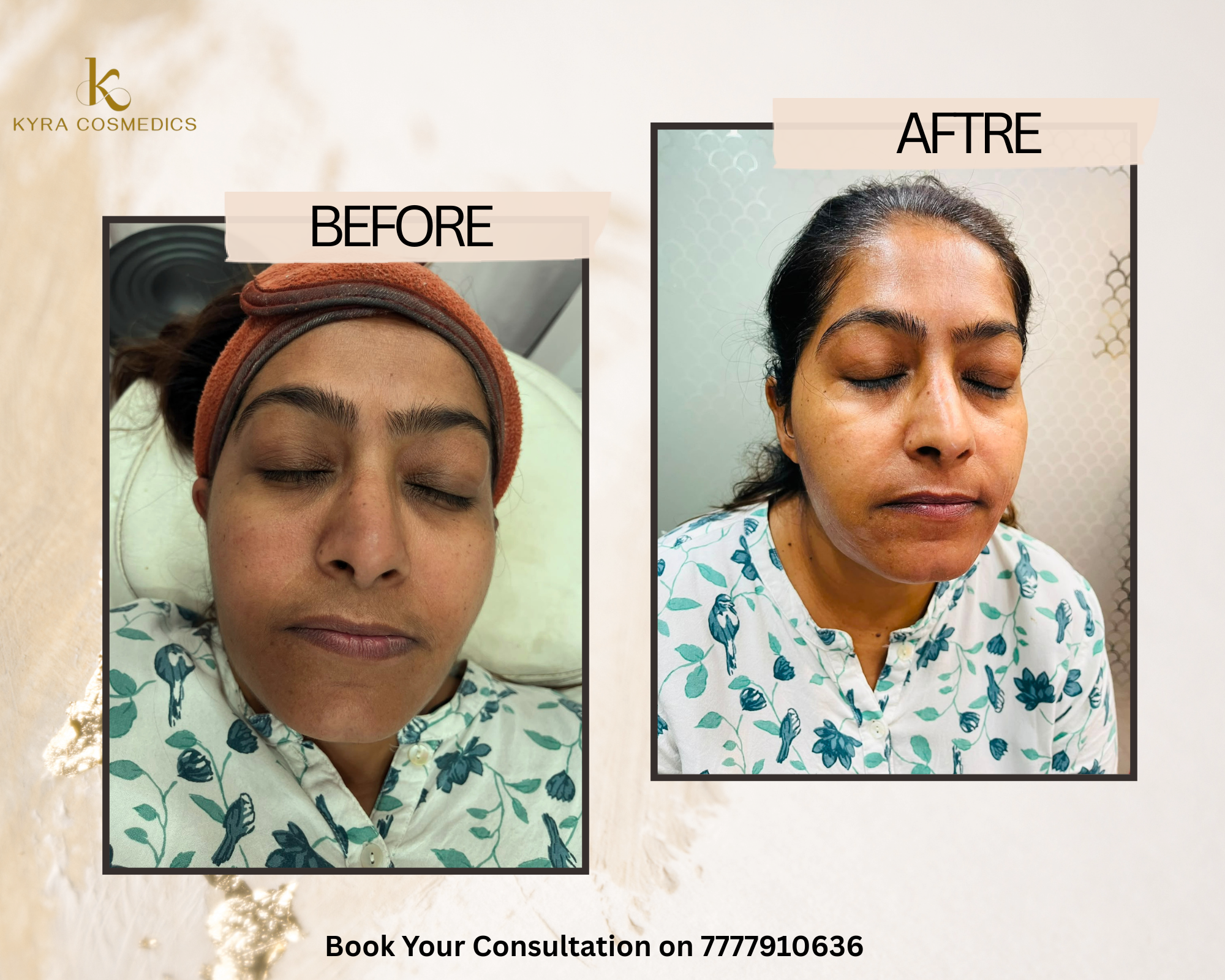 Lip Lightening & Eye Contour Refresh — Real clinical result at Kyra Cosmedics Vadodara