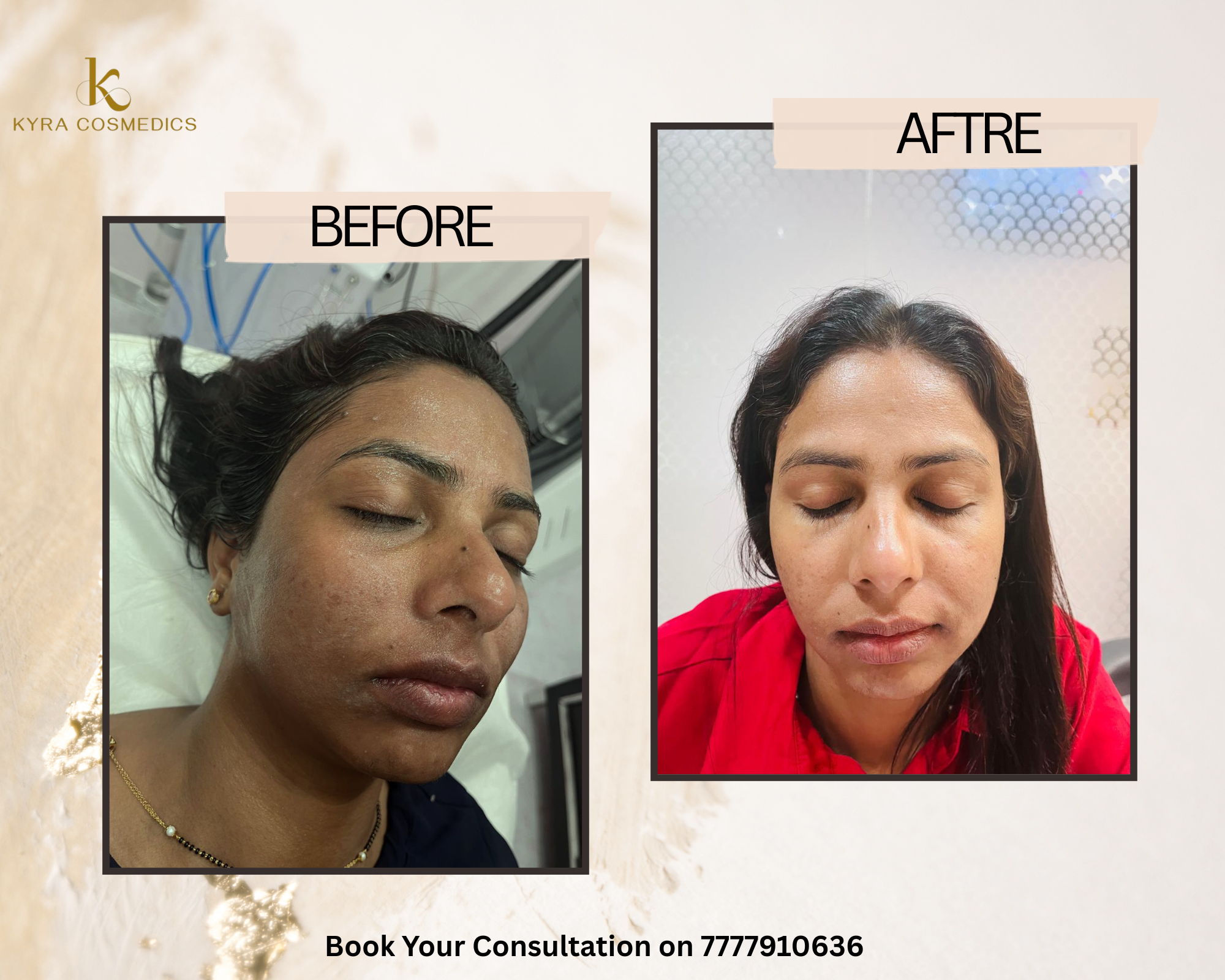 Sun Tan & Deep Pigmentation Removal — Real clinical result at Kyra Cosmedics Vadodara
