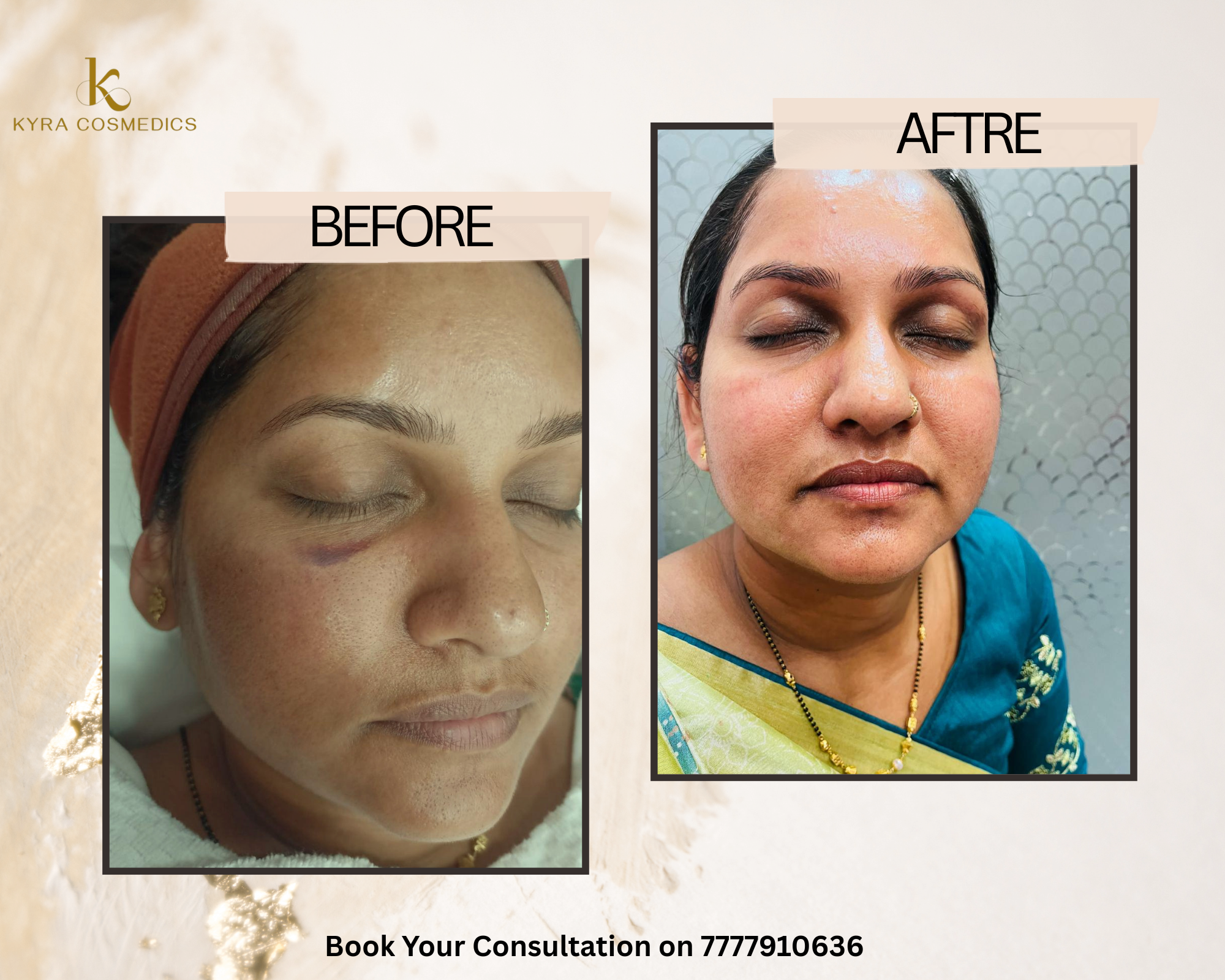 Under-Eye Bruise & Skin Recovery — Real clinical result at Kyra Cosmedics Vadodara