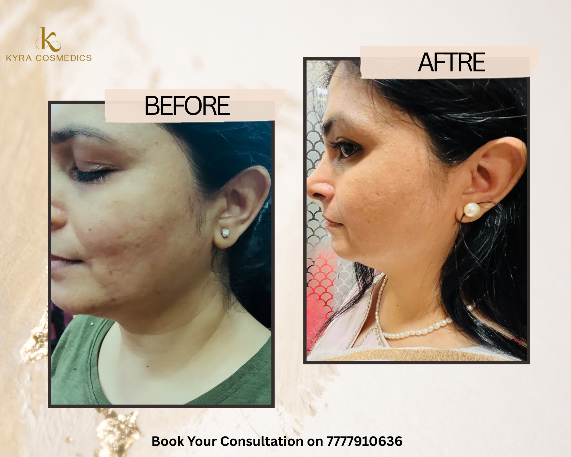 Cheek Acne Scar Resurfacing — Real clinical result at Kyra Cosmedics Vadodara